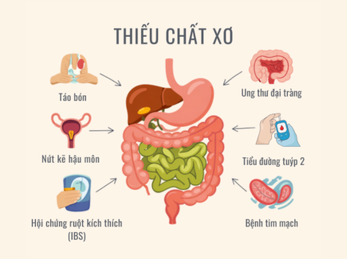 THIẾU CHẤT XƠ: NGUY CƠ TIỀM ẨN ẢNH HƯỞNG ĐẾN SỨC KHỎE BẠN CẦN BIẾT